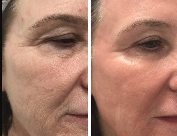 دکتر نعمت الله کهندانی : روش‌ها و تکنیک‌های جوانسازی پوست را توضیح دهید ؟