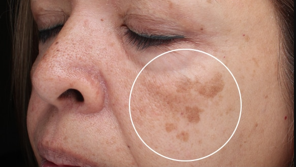 لکه‌های پوستی